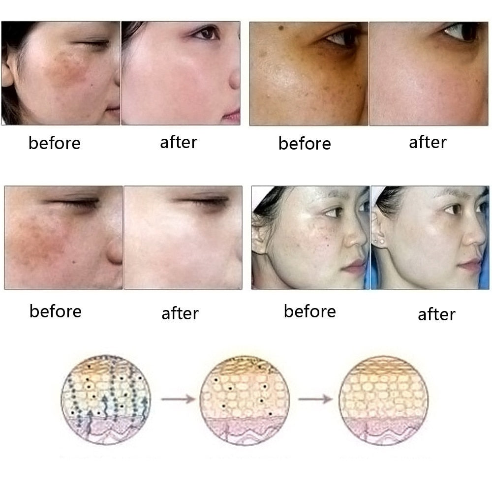 Dredge Meridian Skin Care زيت إزالة الندبات وعلامات التمدد وحب الشباب الطبيعي النقي